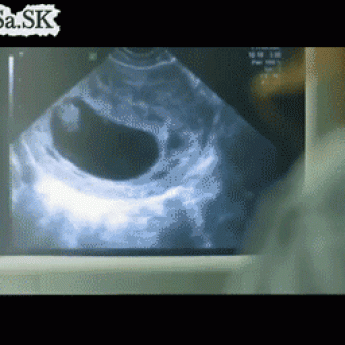 GIF: U gynekológa na ultrazvuku